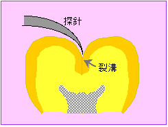 �T�j�ɂ�钎���̐f�f