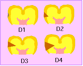 北欧の虫歯診断基準