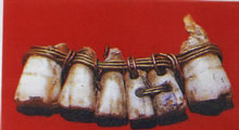 古代人の審美補綴