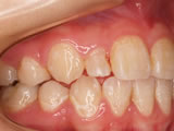 歯の形態異常