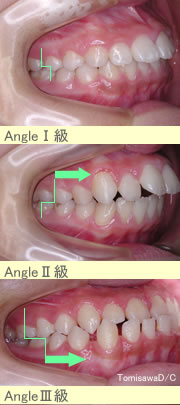 アングル の 不正 咬合
