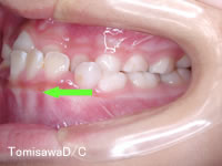 下顎前突症例