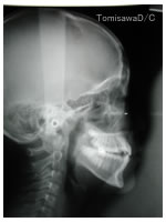 頭部X線規格写真（セファロ）による不正咬合の診査・診断