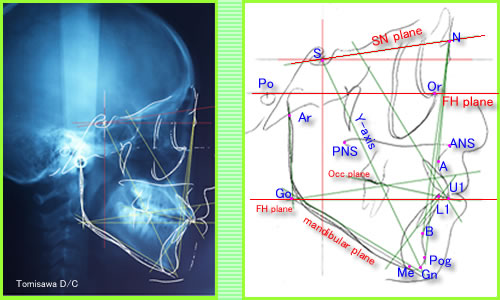 頭部X線規格写真（セファロ）による不正咬合の診査・診断