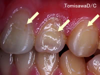 矯正治療による虫歯